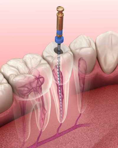 Root Canal Therapy